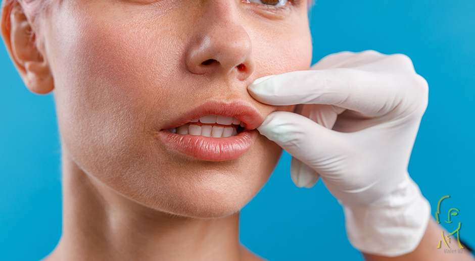 Lip lift, dudak kaldırma